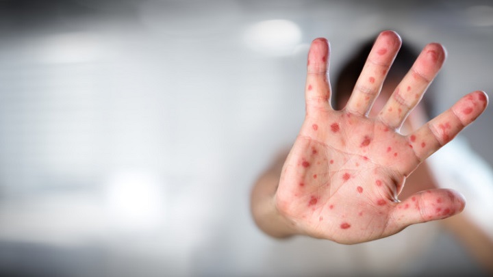 Viral Diseases - Hand Infected - Hand foot and mouth disease HFMD