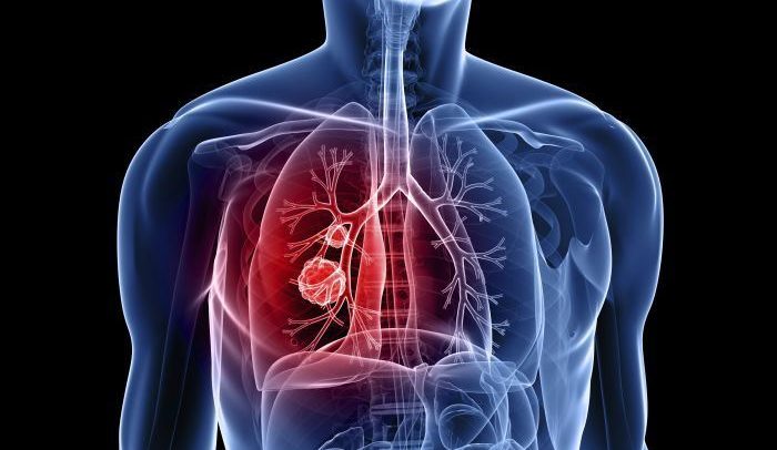 lung cancer