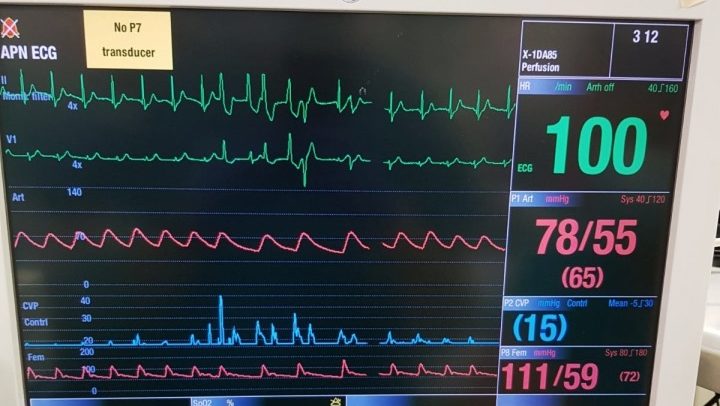 chetvrta transplantacija